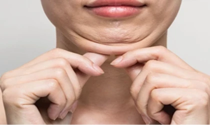 Gıdı Lazer Lipoliz (Lazer ile Gıdı Estetiği) nedir, nasıl yapılır?