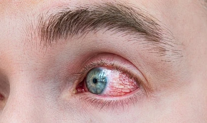 Bahar Alerjisinde Göz Ovalamak Körlüğe Yol Açıyor
